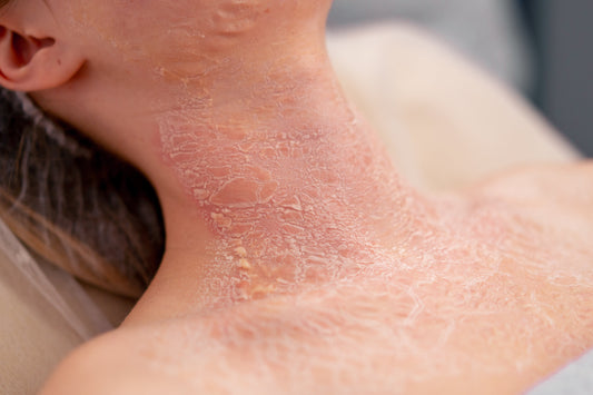 topical steroids eczema skincare barrier repair