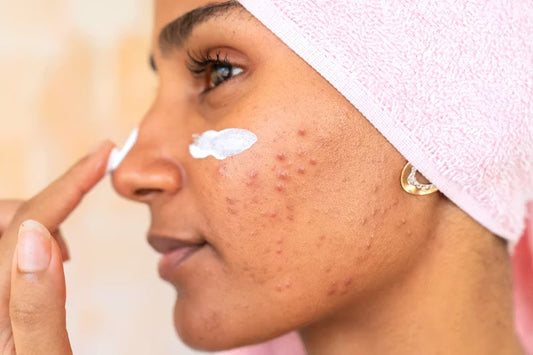 How to Calm Facial Redness: A Barrier-First Approach