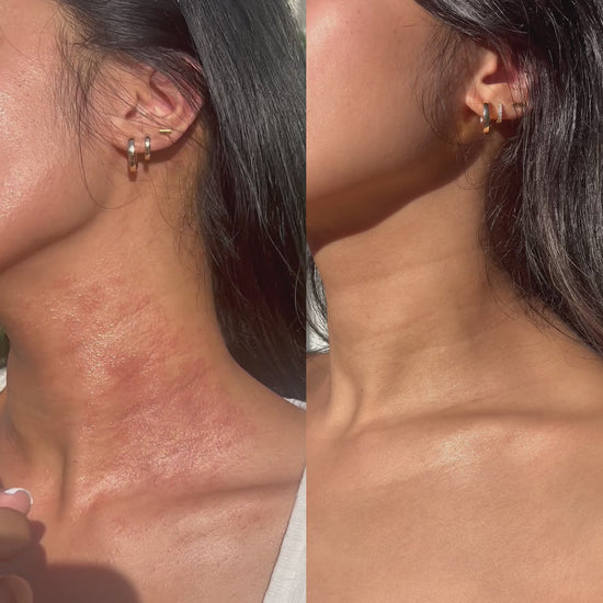 Before and After of woman using the calm and restore duo to relieve her eczema-prone skin and visible irritation.